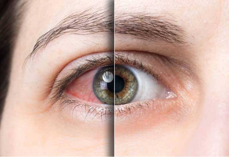 Lasik Laser Corneal Surgery
