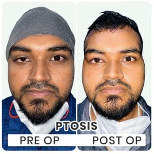 Ptosis Surgeon Indore