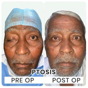 Ptosis Surgery Indore