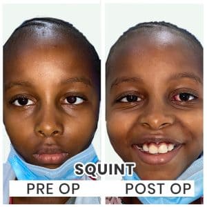 Squint Eye Surgery Indore