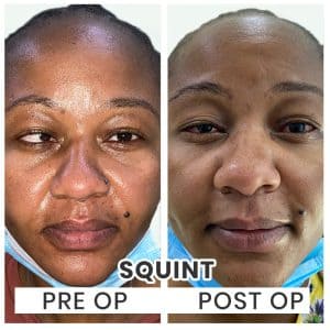 Squint Surgery Cost Indore