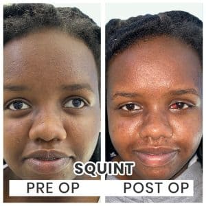 Squint Eye Specialist Indore