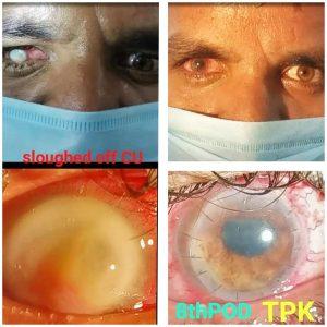 Best Eye Cosmetic Surgeon Indore