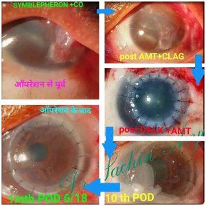 Best Cataract Surge in Indore