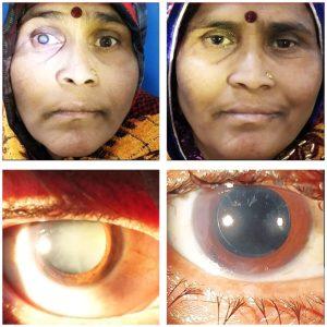 Eyelid Surgeon Indore